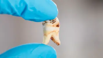 تسوس الأسنان.. الأسباب الصامتة التي تهاجم الفم دون إنذار